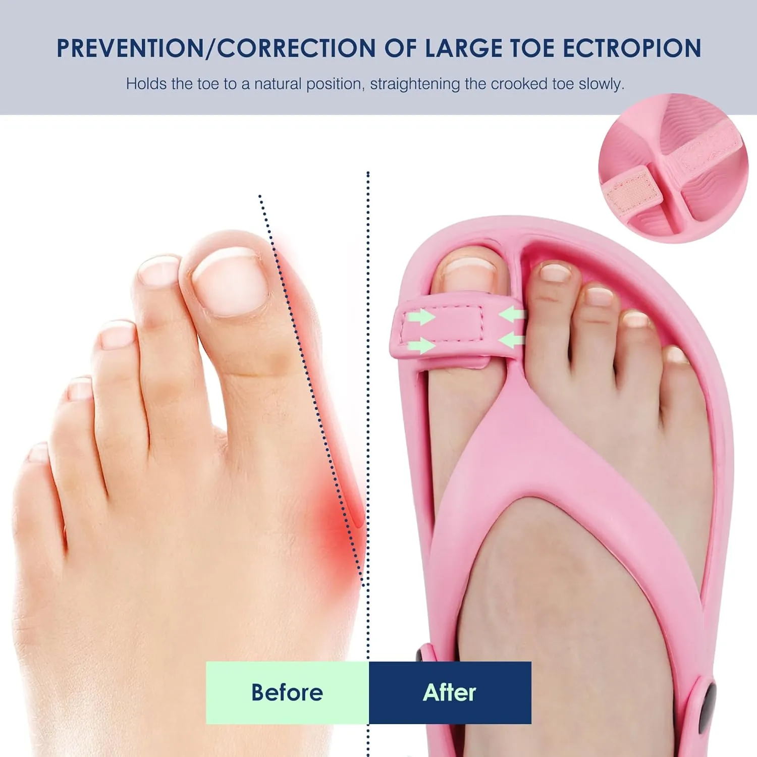 Ortho rest Women Orthopedic Bunion Sandals Orthotic Slides Walking Sandals